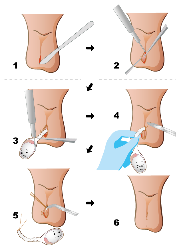 睾丸摘出手術の方法