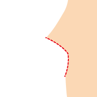 乳房及び乳腺切除、皮膚切除+乳輪移植イメージ3