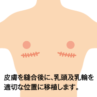乳房及び乳腺切除、皮膚切除+乳輪移植イメージ4