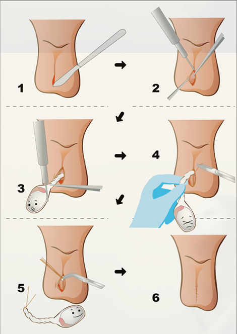 睾丸摘出イメージ画像
