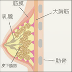 乳腺切除イメージ１