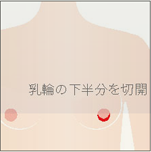 乳腺切除イメージ2