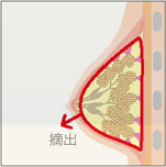 乳腺切除イメージ3