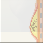 乳腺切除イメージ4